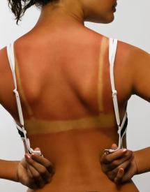 Sun burned lady back