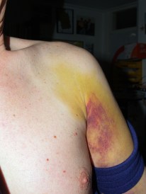 leo gebroken schouder 020407 002 (2)