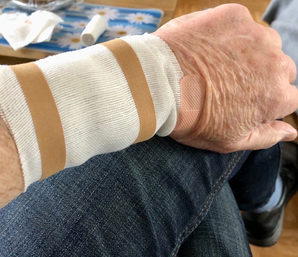 De huidige afbeelding heeft geen alternatieve tekst. De bestandsnaam is: blessure-aan-de-pols-img_4927.jpg